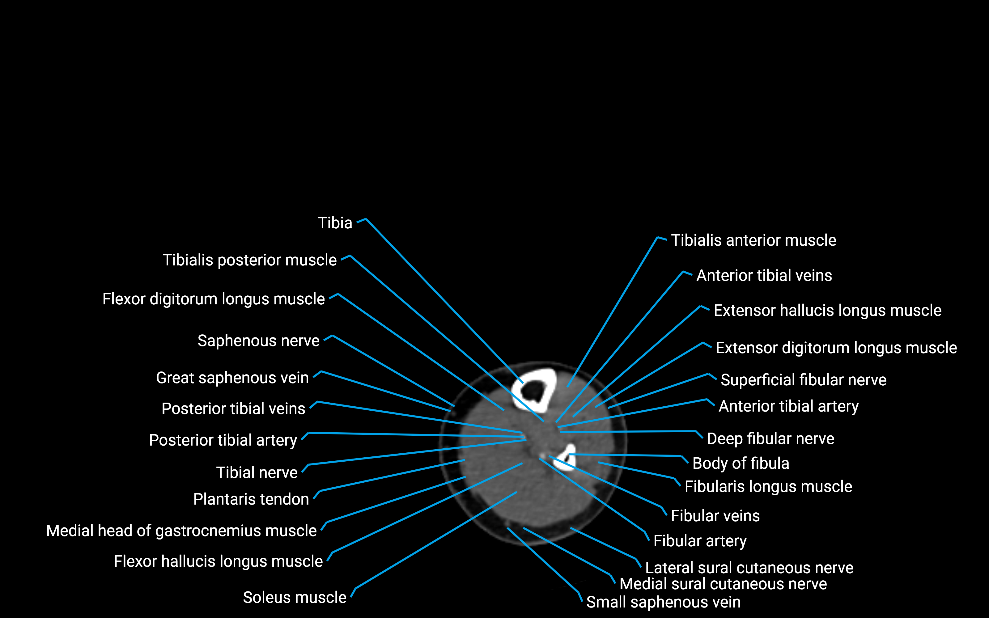 CT Lower leg axial cross sectional anatomy labelled image 123 (2).png